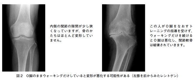 O脚のままウォーキングだけしていると変形が悪化する可能性がある